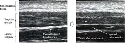 Effect of visual feedback during ultrasound-guided hydrodissection for myofascial pain syndrome: An exploratory, prospective, observational clinical trial on the expectations for treatment